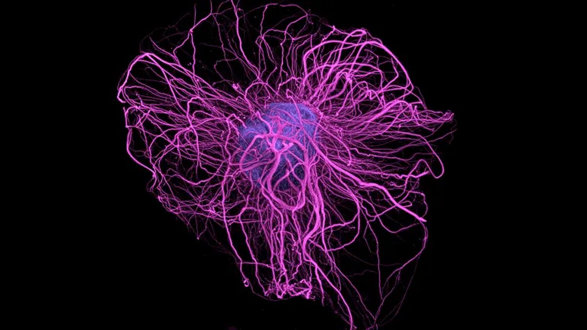 A world-first step toward repairing the Parkinson's brain